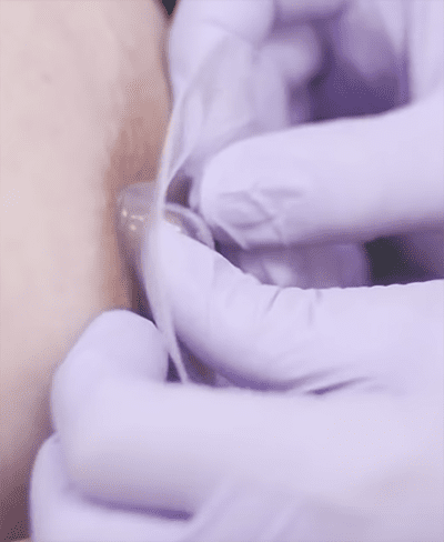 Proper nipple shield size and application Proper nipple shield size and application