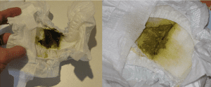 Transitional/Colostrum in a diaper