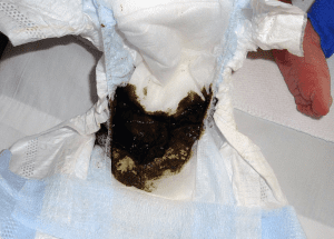 Meconium in a diaper